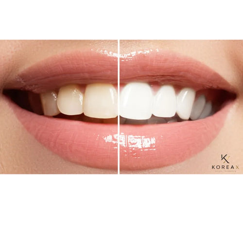Clareador Dental- Dentes de Porcelana |KoreaX